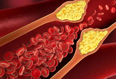 Lipid & Cholesterol Management